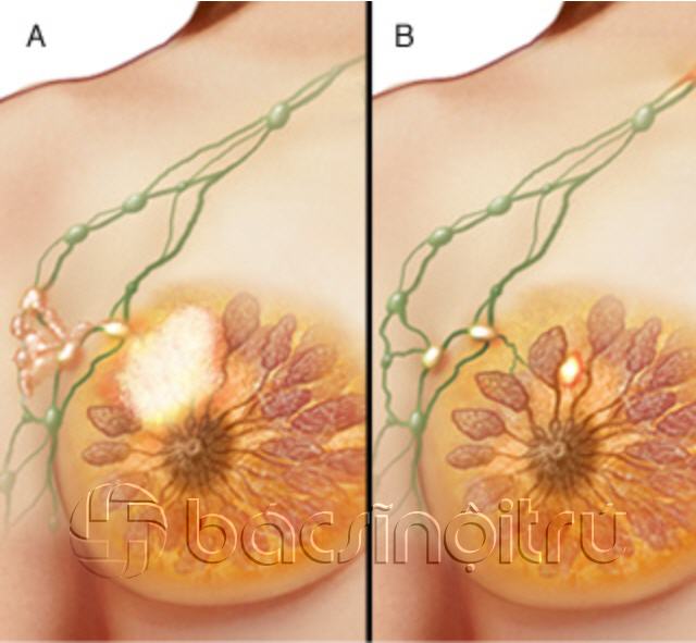 Các giai đoạn của ung thư vú